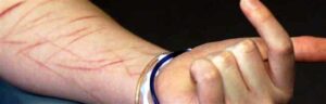 Self-harm is a real thing in girls